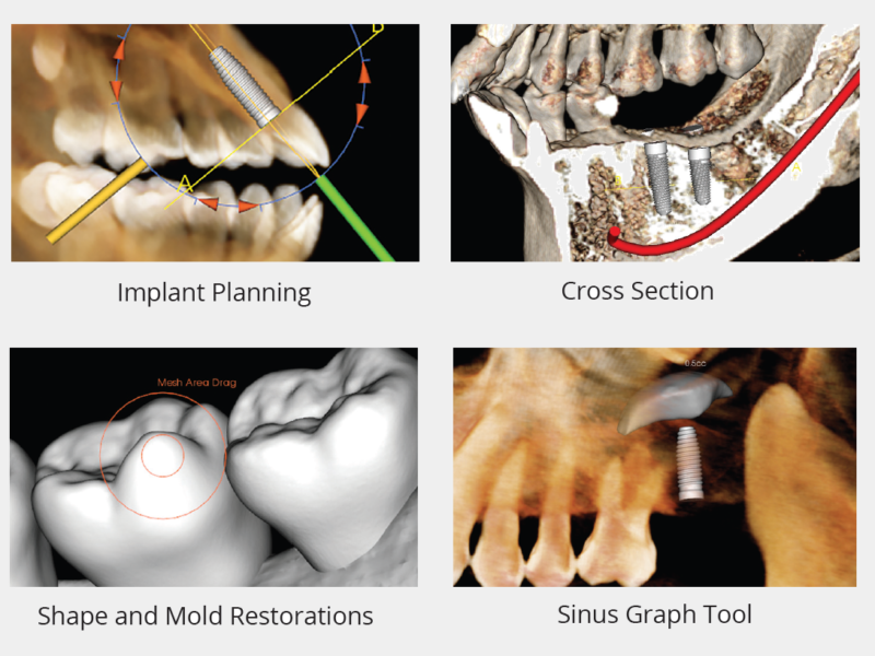 Invivo - Implant planning features SELECTED on grey